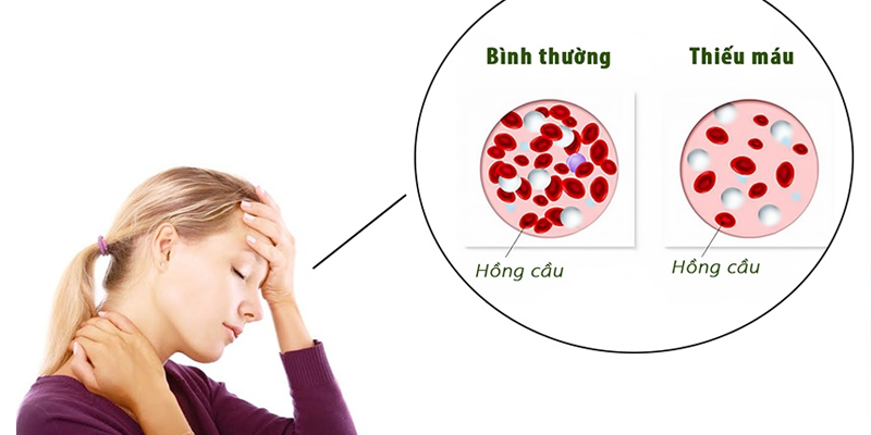 Thiếu máu là một trong các tác dụng phụ có thể gặp trong quá trình điều trị ung thư cổ tử cung