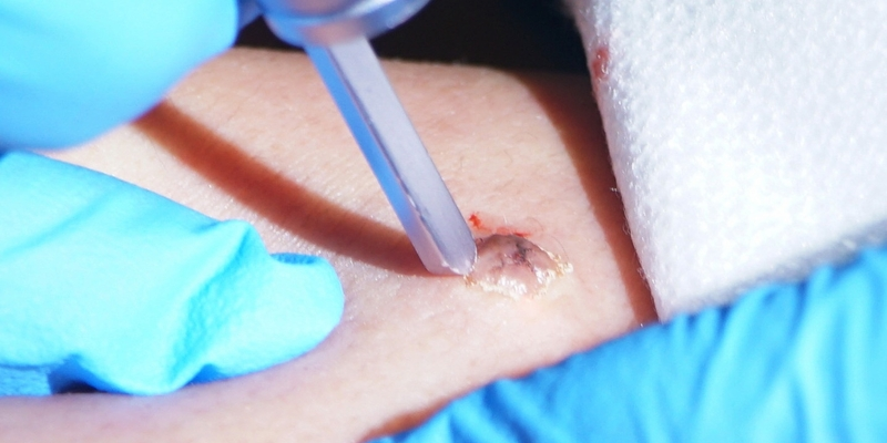 Sử dụng ánh sáng laser để tiêu diệt các tế bào ung thư da