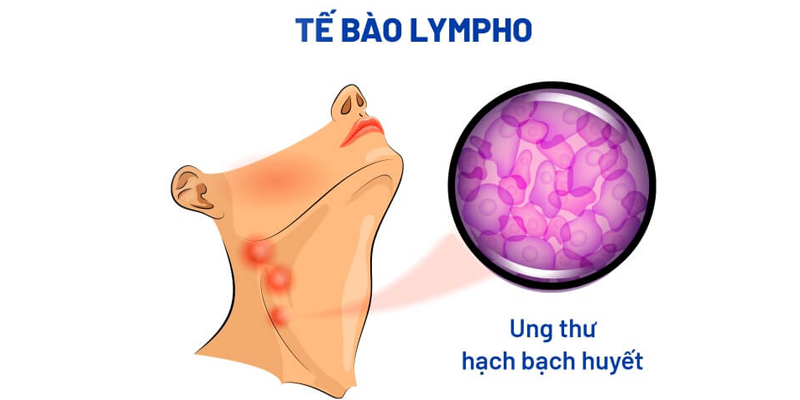 Ung thư hạch bạch huyết có thể xuất hiện ở nhiều đối tượng khác nhau
