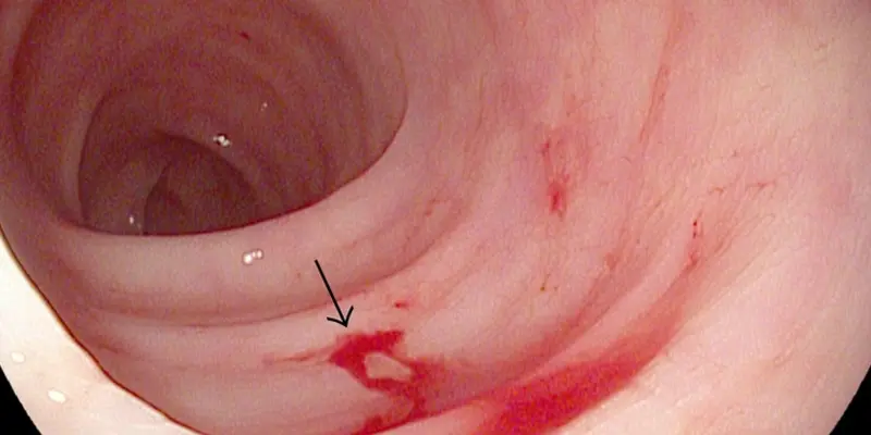 Nội soi trực tràng là một trong những xét nghiệm chẩn đoán