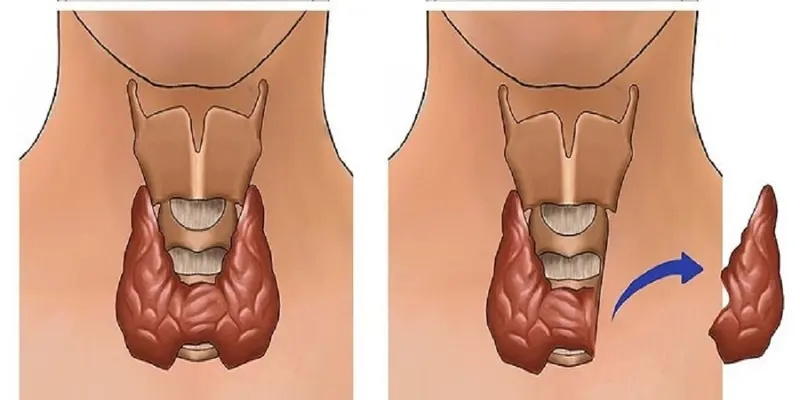 Phẫu thuật thường được đặt ra trong điều trị ung thư tuyến giáp