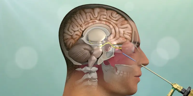 Phẫu thuật thông qua nội soi đường mũi có thể giúp cắt bỏ u tuyến yên