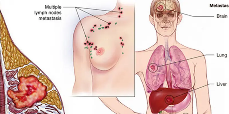 Liệu pháp nội tiết trong điều trị ung thư vú