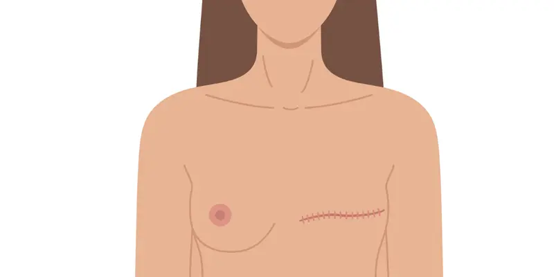 Phương pháp điều trị ung thư vú chủ yếu là cắt bỏ khối u, cố gắng giữ lại nhiều mô vú nhất có thể