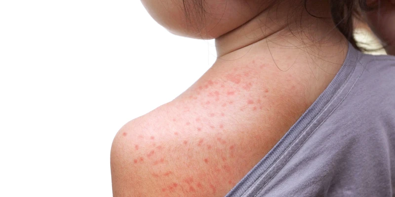 Xuất hiện những đốm đỏ trên da khi mắc bệnh ung thư máu