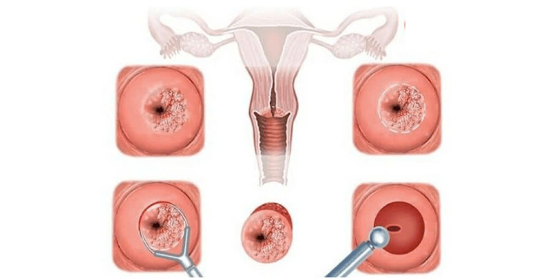 Viêm cổ tử cung có gây ung thư không là băn khoăn của nhiều chị em phụ nữ