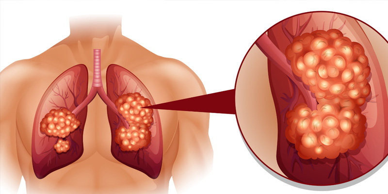 Ung thư phổi tế bào nhỏ (Small Cell Lung Cancer – SCLC) được chia thành ba thể bệnh chính