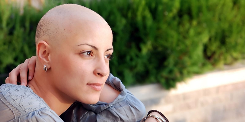 Rụng tóc là tác dụng phụ thường gặp với những bệnh nhân sử dụng phương pháp xạ trị ung thư phổi