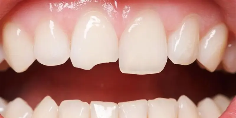 Răng gãy, mẻ gây tổn thương lưỡi là nguyên nhân gây đau rát lưỡi