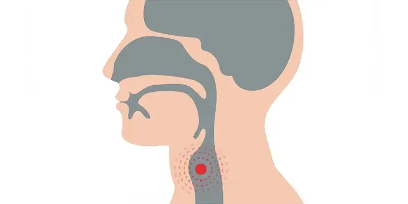 Hình ảnh ung thư thanh quản