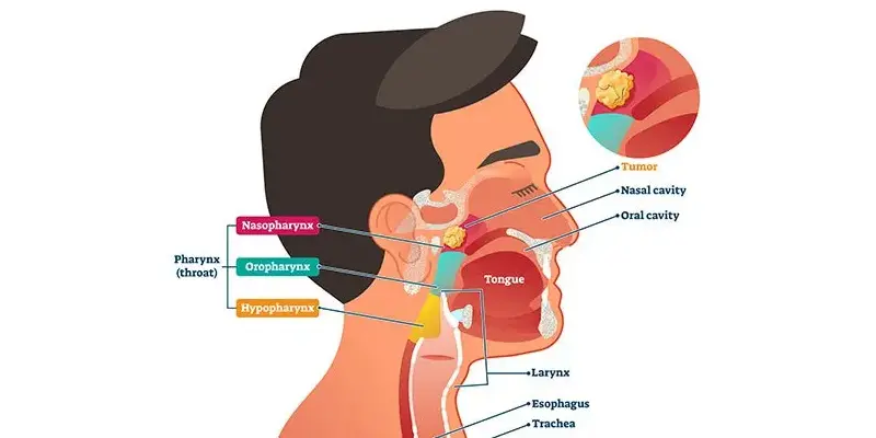 Hình ảnh ung thư vòm họng giai đoạn 1
