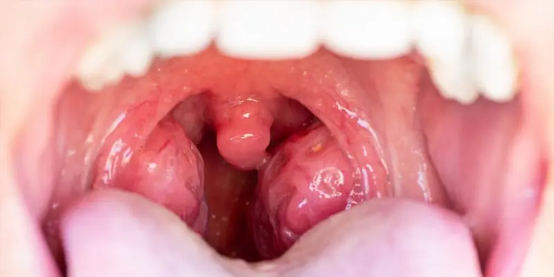 Hình ảnh ung thư vòm họng