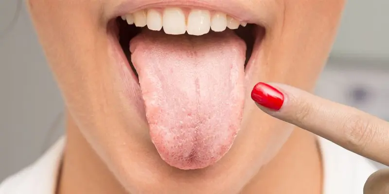 Viêm lưỡi là gì