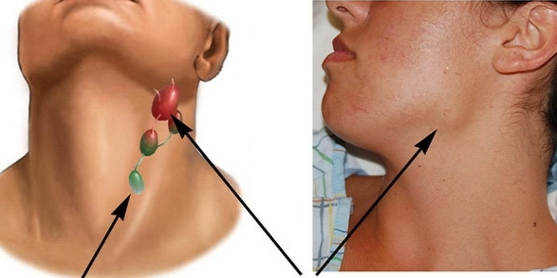 Điều trị bệnh u lympho không Hodgkin phức tạp trong kiểm soát các triệu chứng
