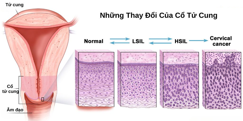 HSIL là một dạng tổn thương bất thường của tế bào vảy, liên quan đến virus HPV