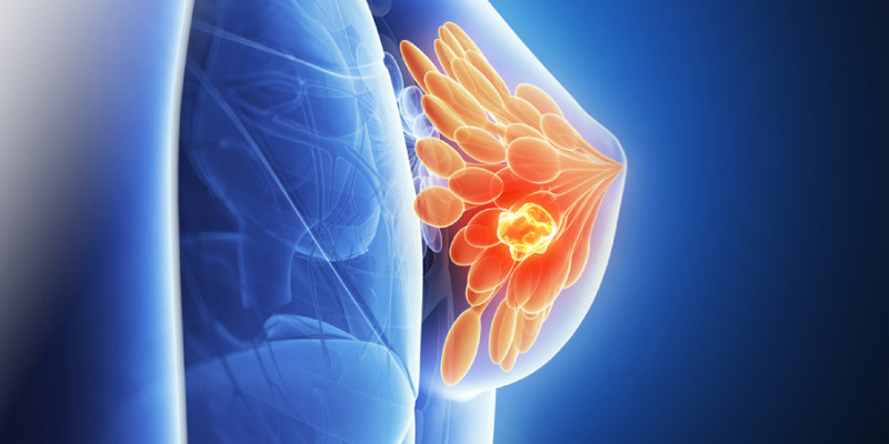 Đôi khi kết quả chẩn đoán ung thư vú có thể sai nhưng tỷ lệ này không đáng kể.