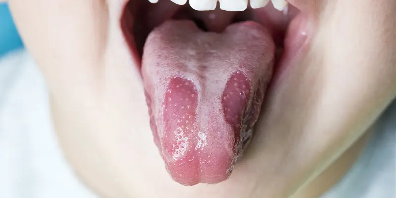 Ung thư lưỡi là tình trạng tế bào ác tính hình thành trên bề mặt hoặc sâu bên trong mô lưỡi.