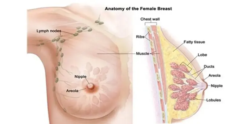 Ung thư vú đa số xảy ra ở ống dẫn sữa và tiểu thùy 