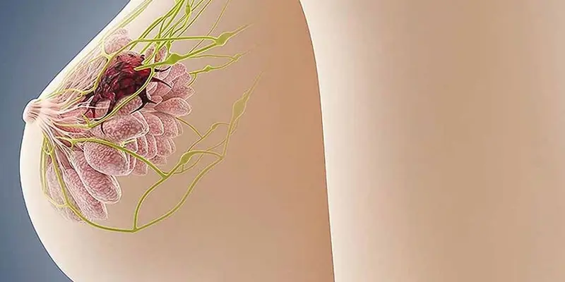 Khối u hình thành là do tế bào phát triển bất thường