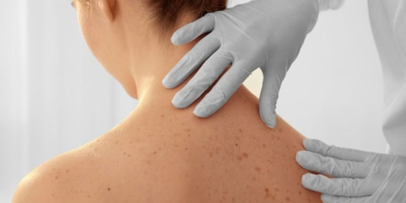 Ung thư da là sự phát triển không bình thường của các tế bào da