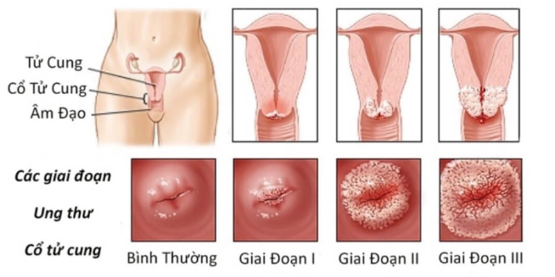 Ung thư ở cổ tử cung là căn bệnh ác tính ảnh hưởng trực tiếp đến đời sống của các chị em phụ nữ