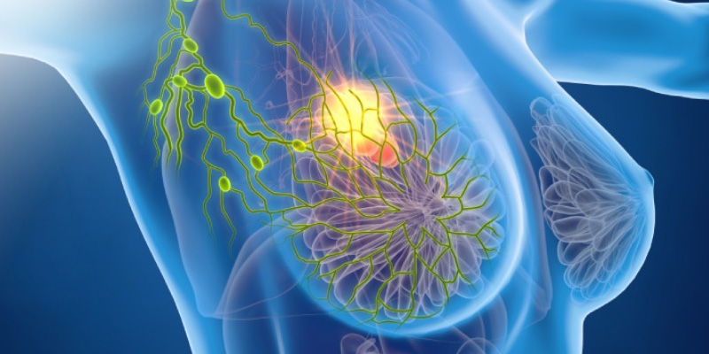 Phẫu thuật ung thư vú cần thiết ở hầu hết các giai đoạn, trừ giai đoạn cuối (Giai đoạn IV – ung thư vú di căn).