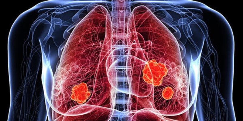 U phổi bao gồm hai loại u lành tính và u ác tính ung thư phổi