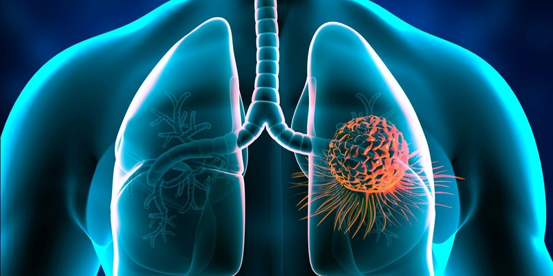 Tỷ lệ điều trị khỏi hoàn toàn ung thư phổi giai đoạn 2 khá cao