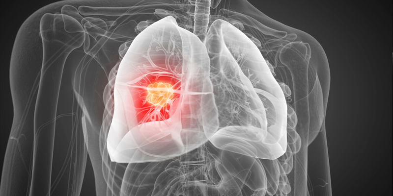 Ung thư phổi giai đoạn 2 gây nhiều thách thức trong quá trình điều trị