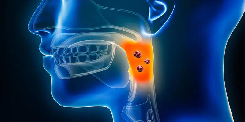 Liệu rằng ung thư khoang miệng có chữa được không