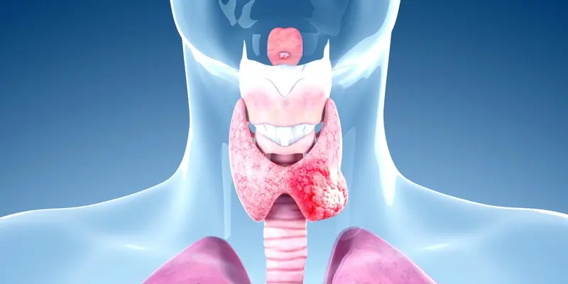 Ung thư tuyến giáp di căn có chữa được không tùy thuộc vào nhiều yếu tố