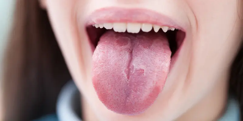 Lưỡi có đốm đỏ có thể do bệnh tưa miệng