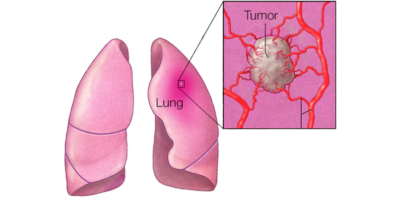 Phụ nữ không hút thuốc vẫn có nguy cơ mắc ung thư phổi
