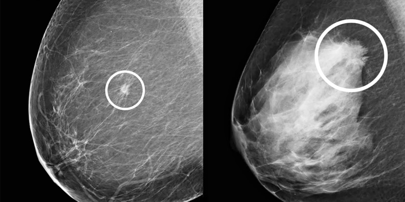 Mô vú dày đặc màu trắng trên phim chụp X-quang tuyến vú