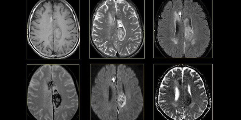 MRI chẩn đoán ung thư não