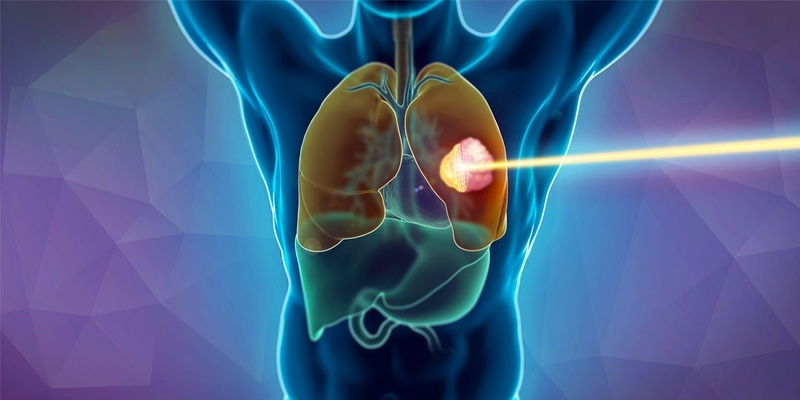 Xạ trị ung thư phổi sống được bao lâu