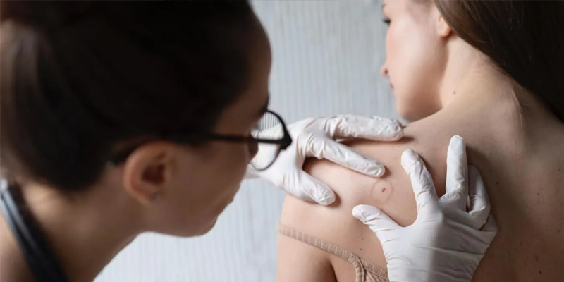 Ngứa dữ dội có liên quan đến giai đoạn muộn của ung thư da không