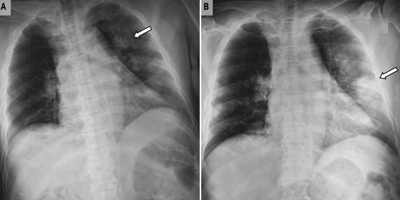 Bệnh phổi trắng sống được bao lâu là điều nhiều người bệnh quan tâm