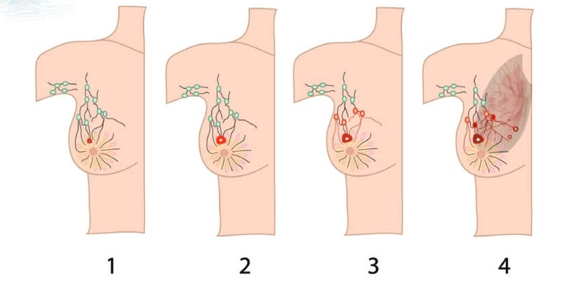 Tốc độ ung thư vú phát triển nhanh như thế nào do nhiều yếu tố gây nên