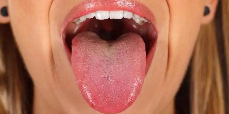 Ung thư lưỡi là nguyên nhân cần đặc biệt cảnh giác