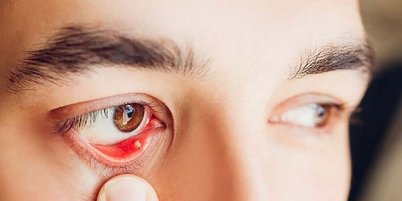Virus HPV là nguyên nhân hàng đầu gây bệnh u kết mạc mắt