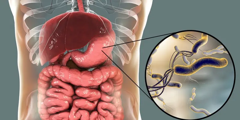 Loét dạ dày do vi khuẩn Helicobacter pylori làm tăng nguy cơ ung thư dạ dày