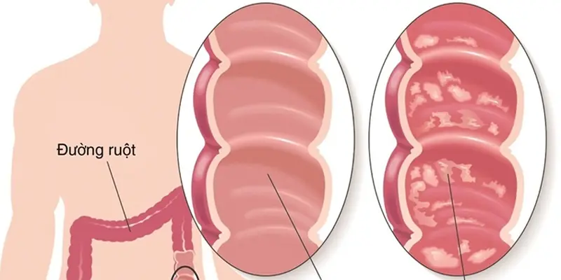 Người mắc bệnh viêm ruột làm tăng nguy cơ ung thư đại tràng