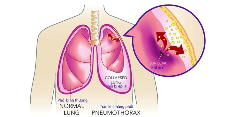 Ung thư màng phổi gây ảnh hưởng đến sức khỏe