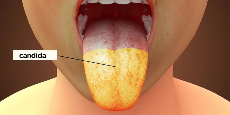 Viêm lưỡi do candida