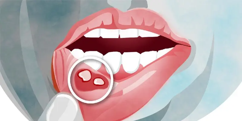 Nhiệt miệng cũng là nguyên nhân phổ biến gây lưỡi có đốm đỏ