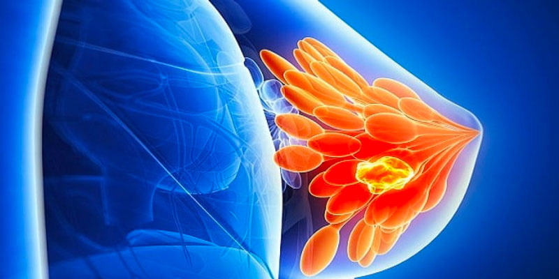 U nang vú là khối u lành tính không tác động nhiều đến sức khỏe