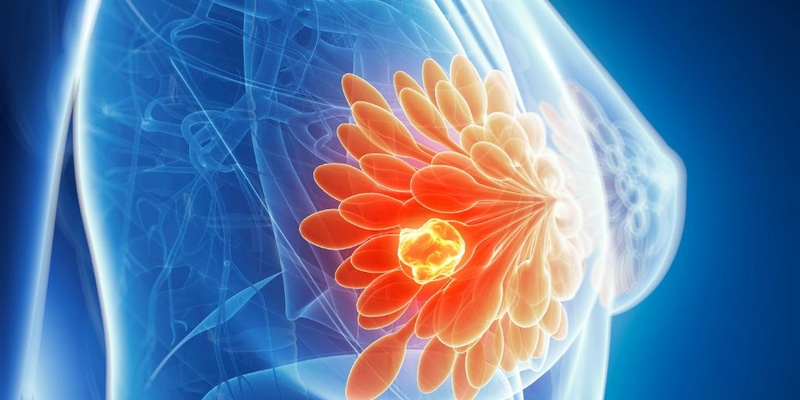 Nguyên nhân gây u xơ tuyến vú