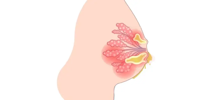 Phần lớn dịch tiết ở núm vú không phải ung thư nhưng vẫn thuộc dấu hiệu ung thư vú ở một số người