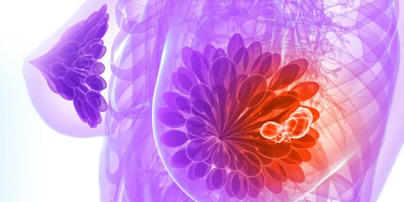 Ung thư biểu mô tuyến là tình trạng tế bào ung thư bắt đầu từ tế bào mô tuyến (thường có trong ống dẫn và tiểu thùy vú)